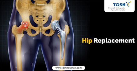 Congenital hip dislocation in childeren